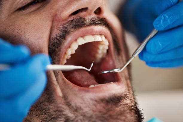 Best Emergency Dentist for Lost Fillings or Crowns in Bottineau, ND